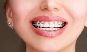 5 أنواع مختلفة لتقويم الأسنان! فكيف تختار تقويم اسنان مناسب لك؟