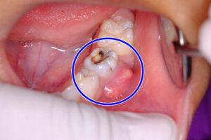 خُراج الأسنان الجذري، الدليل الكامل لاسبابه وطرق الوقاية.
