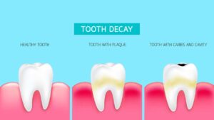 تجنب تسوس الأسنان: أسبابه وطرق الوقاية، عيادات خبراء الأسنان