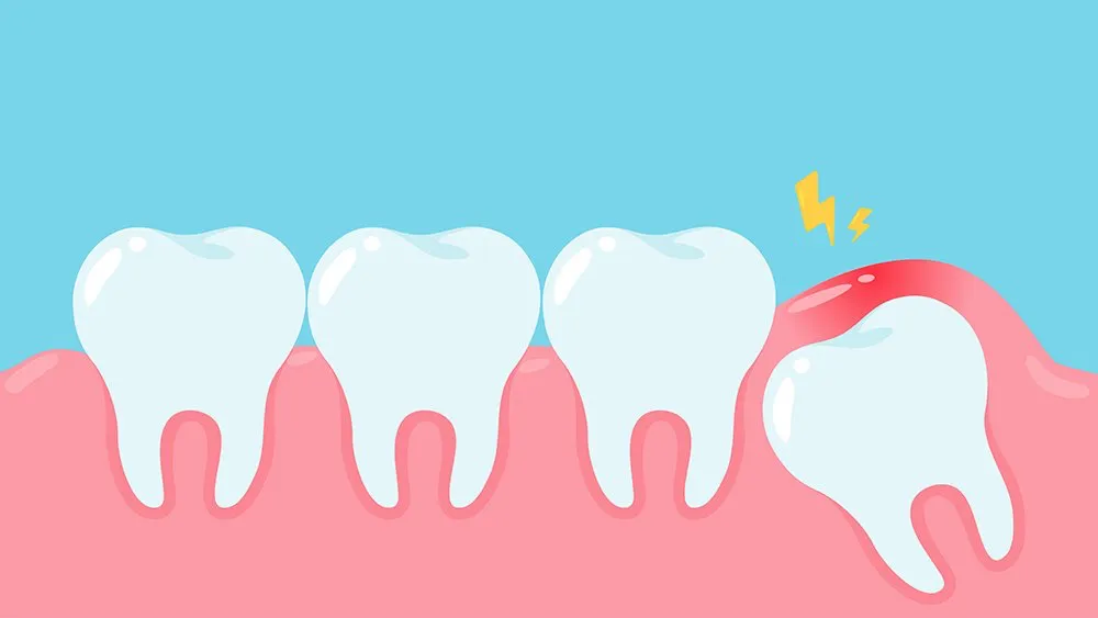 ما وراء استئصال ضرس العقل | عيادات خبراء الأسنان