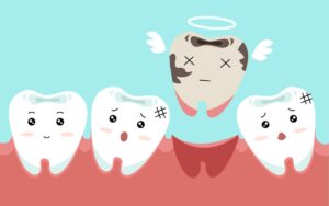 طرق علاج تسوس الأسنان الأكثر فاعلية | عيادات خبراء الأسنان